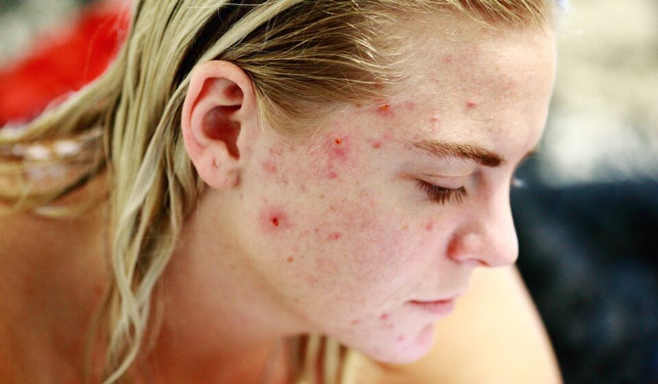 struggle, acne, self love, skin, face, portrait, woman, people, reality, girl, female, model, hair, person, human, skincare, character, caucasian, blemishes, pimples, no make up, life, problems, issues, self esteem, brown love, brown life, brown model, brown hair, brown human, acne, acne, acne, acne, acne, pimples, pimples